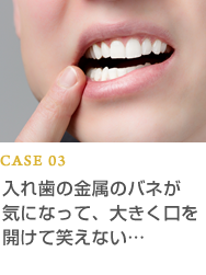 CASE03 入れ歯の金属のバネが気になって、大きく口を開けて笑えない…