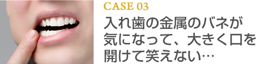 CASE03 入れ歯の金属のバネが気になって、大きく口を開けて笑えない…