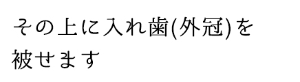 その上に入れ歯(外冠)を被せます